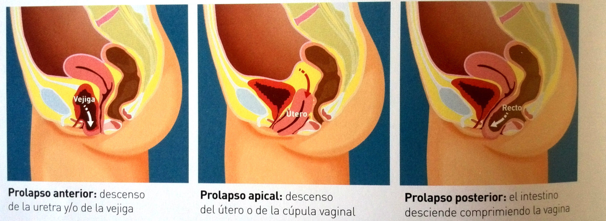 Uroginecologo Especialista En Prolapso Genital Tratamiento